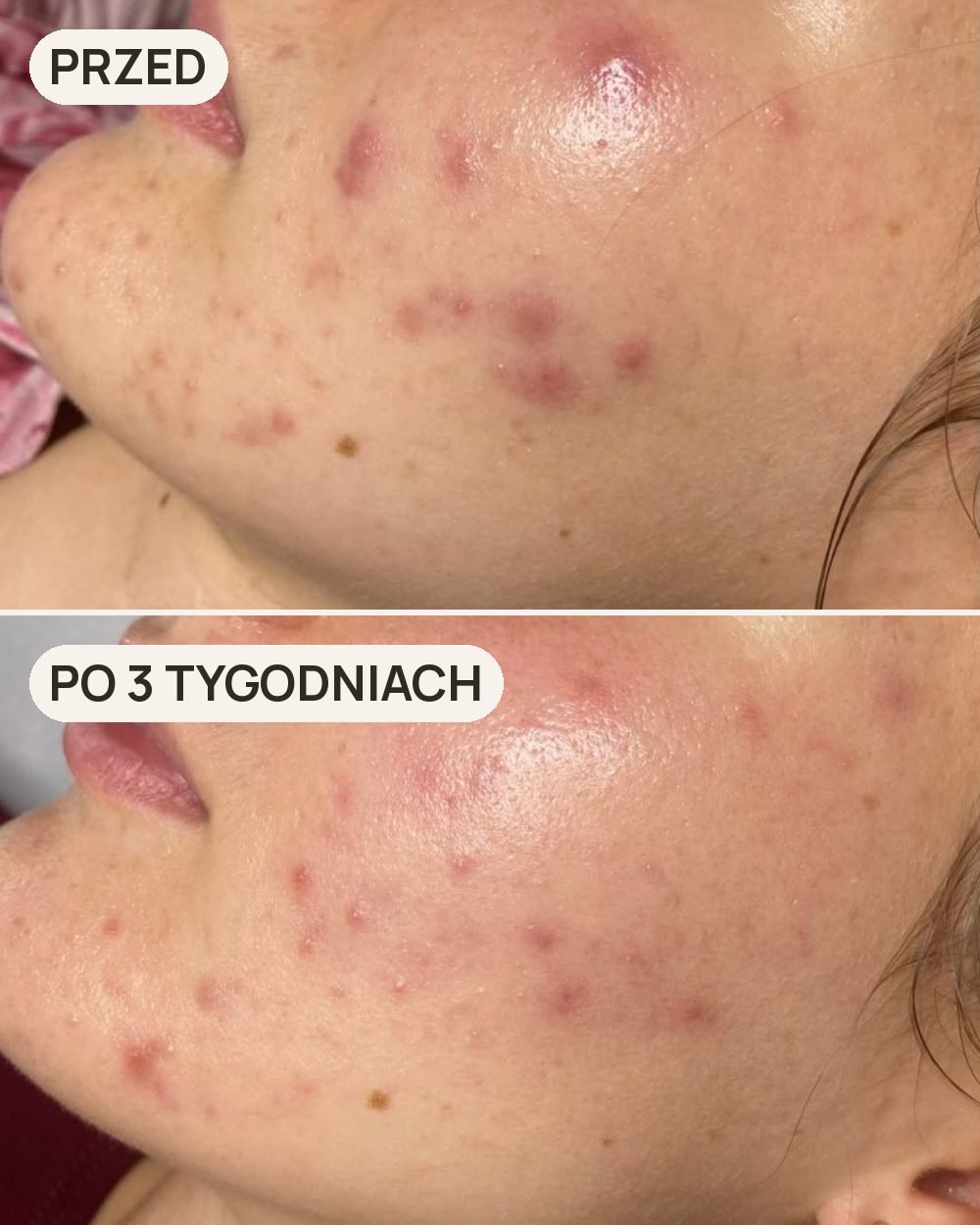 Terapia skóry trądzikowej: 3 tygodnie, 2 zabiegi